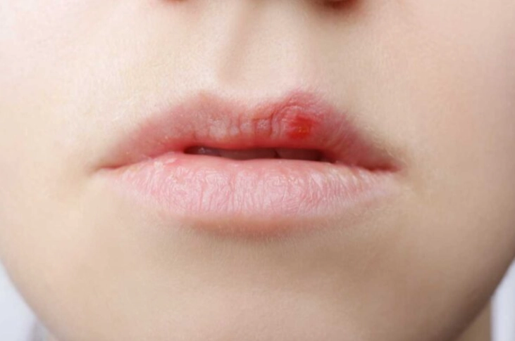 唇皰疹會自己好嗎？完整解析自癒過程、時間與治療選擇