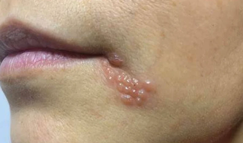 唇皰疹原因