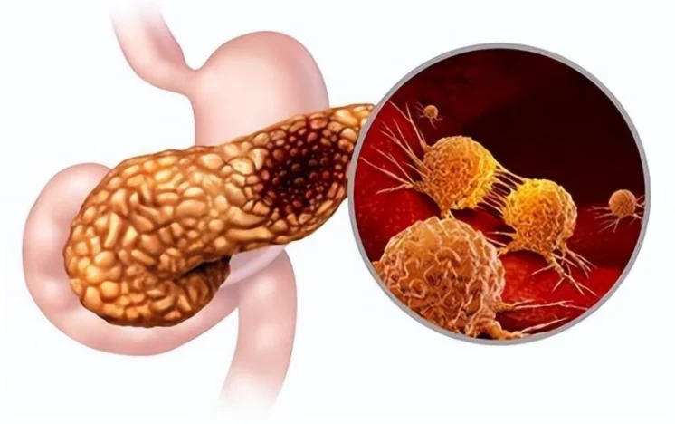 胰臟炎禁食多久