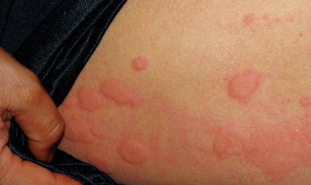 帶狀皰疹可以喝牛奶嗎